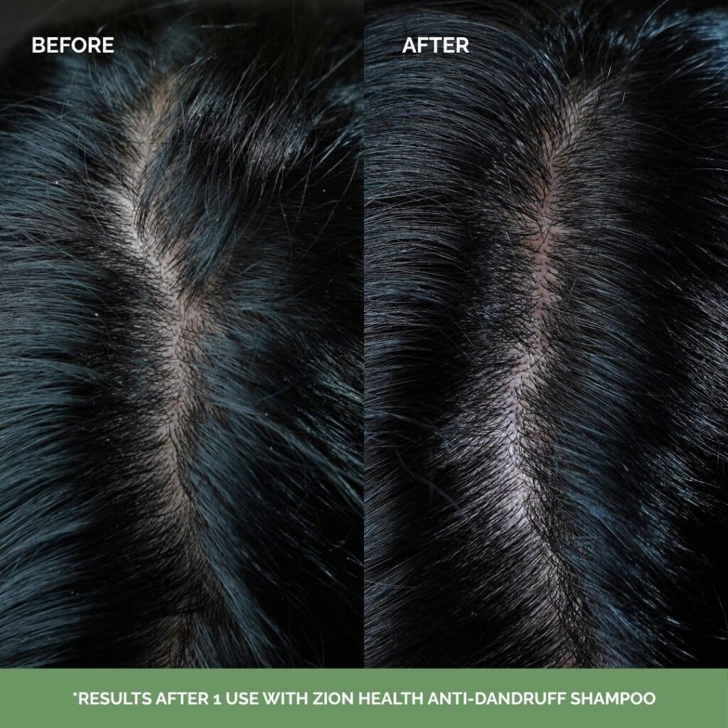 Anti-Dandruff Shampoo