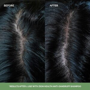 Anti-Dandruff Shampoo